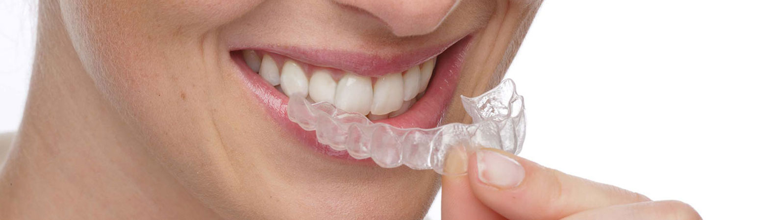 Invisalign